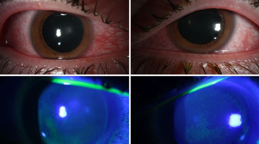 201125-cornea-inflammation-al-1433-3431146